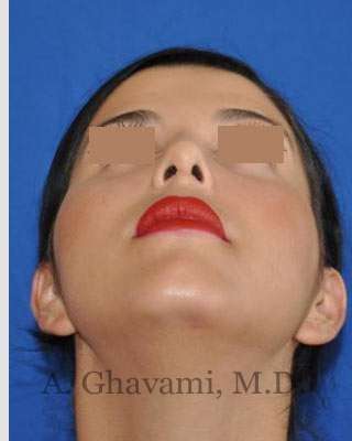 Ethnic Rhinoplasty Before & After Patient #7152