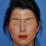 Ethnic Rhinoplasty Before & After Patient #7152