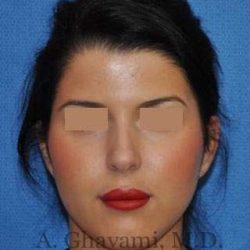 Ethnic Rhinoplasty Before & After Patient #7152