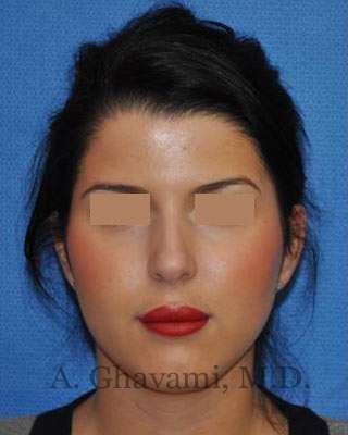 Ethnic Rhinoplasty Before & After Patient #7152