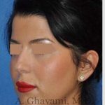 Ethnic Rhinoplasty Before & After Patient #7152
