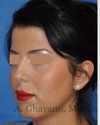 Ethnic Rhinoplasty Before & After Patient #7152