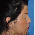 Ethnic Rhinoplasty Before & After Patient #7152