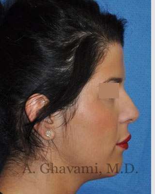 Ethnic Rhinoplasty Before & After Patient #7152