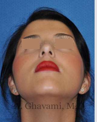 Ethnic Rhinoplasty Before & After Patient #7152