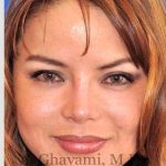 Ethnic Rhinoplasty Before & After Patient #7143
