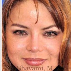 Ethnic Rhinoplasty Before & After Patient #7143