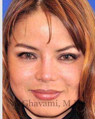 Ethnic Rhinoplasty Before & After Patient #7143