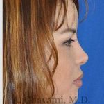 Ethnic Rhinoplasty Before & After Patient #7143