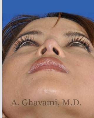 Ethnic Rhinoplasty Before & After Patient #7143