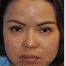 Ethnic Rhinoplasty Before & After Patient #7143