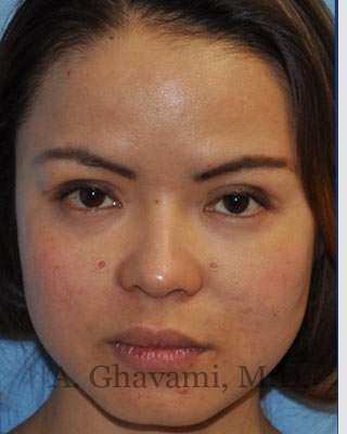 Ethnic Rhinoplasty Before & After Patient #7143