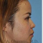 Ethnic Rhinoplasty Before & After Patient #7143