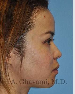 Ethnic Rhinoplasty Before & After Patient #7143