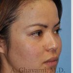 Ethnic Rhinoplasty Before & After Patient #7143
