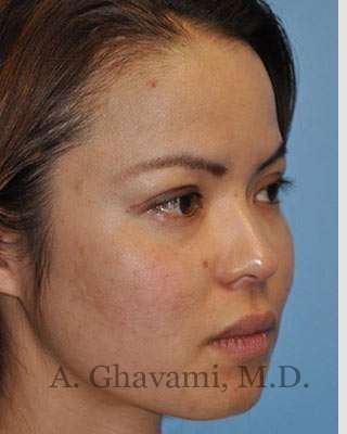 Ethnic Rhinoplasty Before & After Patient #7143