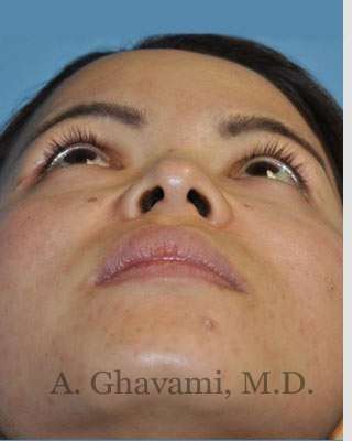Ethnic Rhinoplasty Before & After Patient #7143