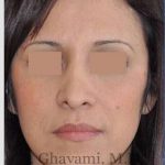 Rhinoplasty Before & After Patient #7134