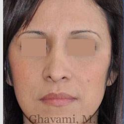 Rhinoplasty Before & After Patient #7134
