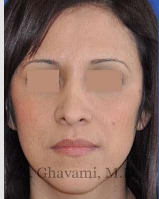 Rhinoplasty Before & After Patient #7134