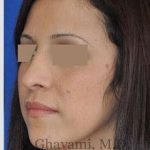 Rhinoplasty Before & After Patient #7134