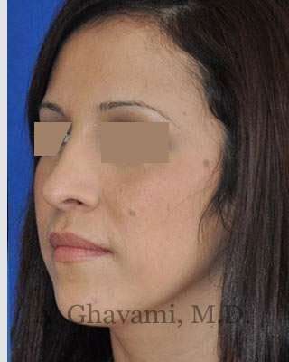Rhinoplasty Before & After Patient #7134