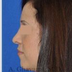 Rhinoplasty Before & After Patient #7134
