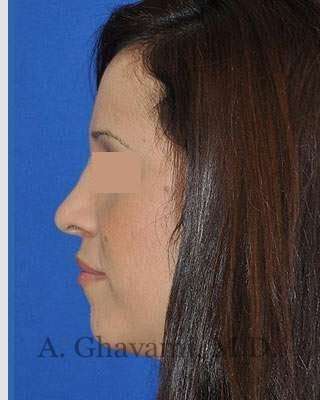 Rhinoplasty Before & After Patient #7134