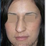 Rhinoplasty Before & After Patient #7134