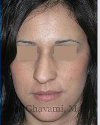 Rhinoplasty Before & After Patient #7134