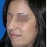 Rhinoplasty Before & After Patient #7134