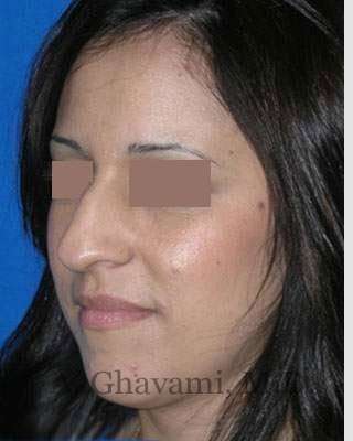 Rhinoplasty Before & After Patient #7134