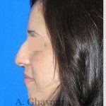Rhinoplasty Before & After Patient #7134