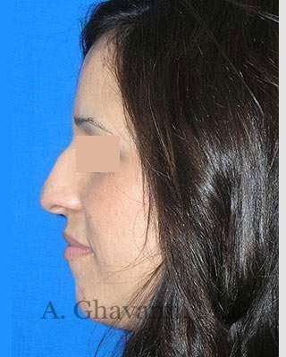 Rhinoplasty Before & After Patient #7134
