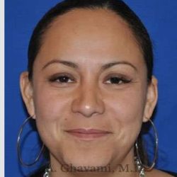 Ethnic Rhinoplasty Before & After Patient #7127