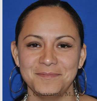 Ethnic Rhinoplasty Before & After Patient #7127