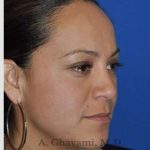 Ethnic Rhinoplasty Before & After Patient #7127