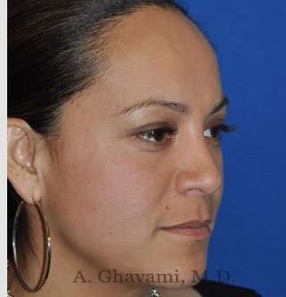 Ethnic Rhinoplasty Before & After Patient #7127