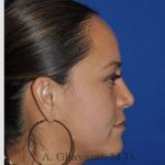 Ethnic Rhinoplasty Before & After Patient #7127