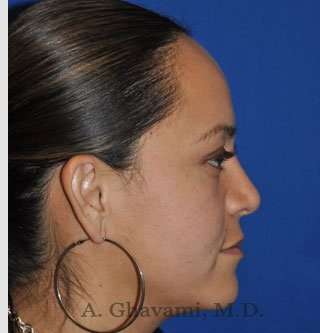 Ethnic Rhinoplasty Before & After Patient #7127