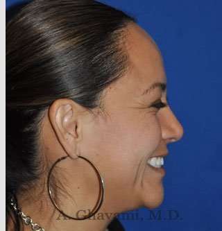 Ethnic Rhinoplasty Before & After Patient #7127