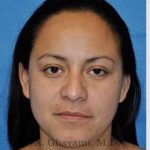 Ethnic Rhinoplasty Before & After Patient #7127