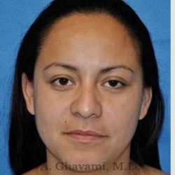 Ethnic Rhinoplasty Before & After Patient #7127