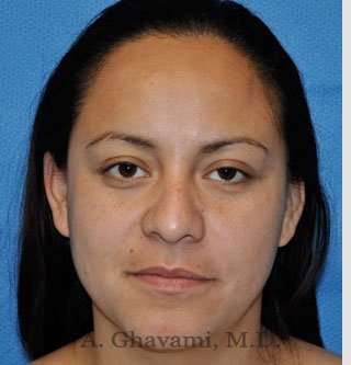 Ethnic Rhinoplasty Before & After Patient #7127