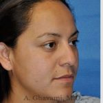 Ethnic Rhinoplasty Before & After Patient #7127