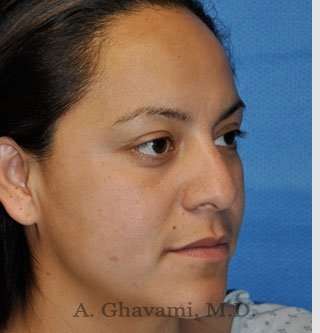 Ethnic Rhinoplasty Before & After Patient #7127