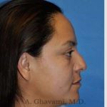 Ethnic Rhinoplasty Before & After Patient #7127