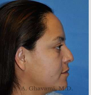 Ethnic Rhinoplasty Before & After Patient #7127