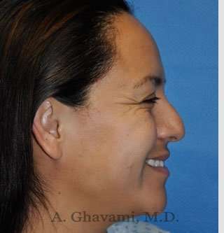 Ethnic Rhinoplasty Before & After Patient #7127