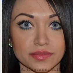 Revision Rhinoplasty Before & After Patient #7118